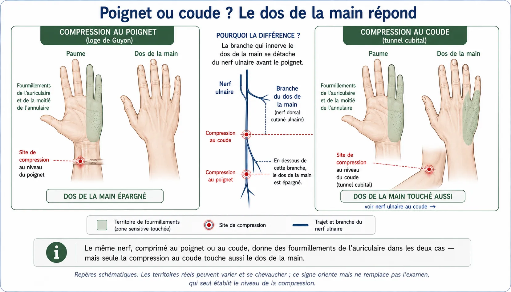 Atteinte du nerf ulnaire au niveau de la loge de Guyon et en aval ( 2a) — illustration médicale