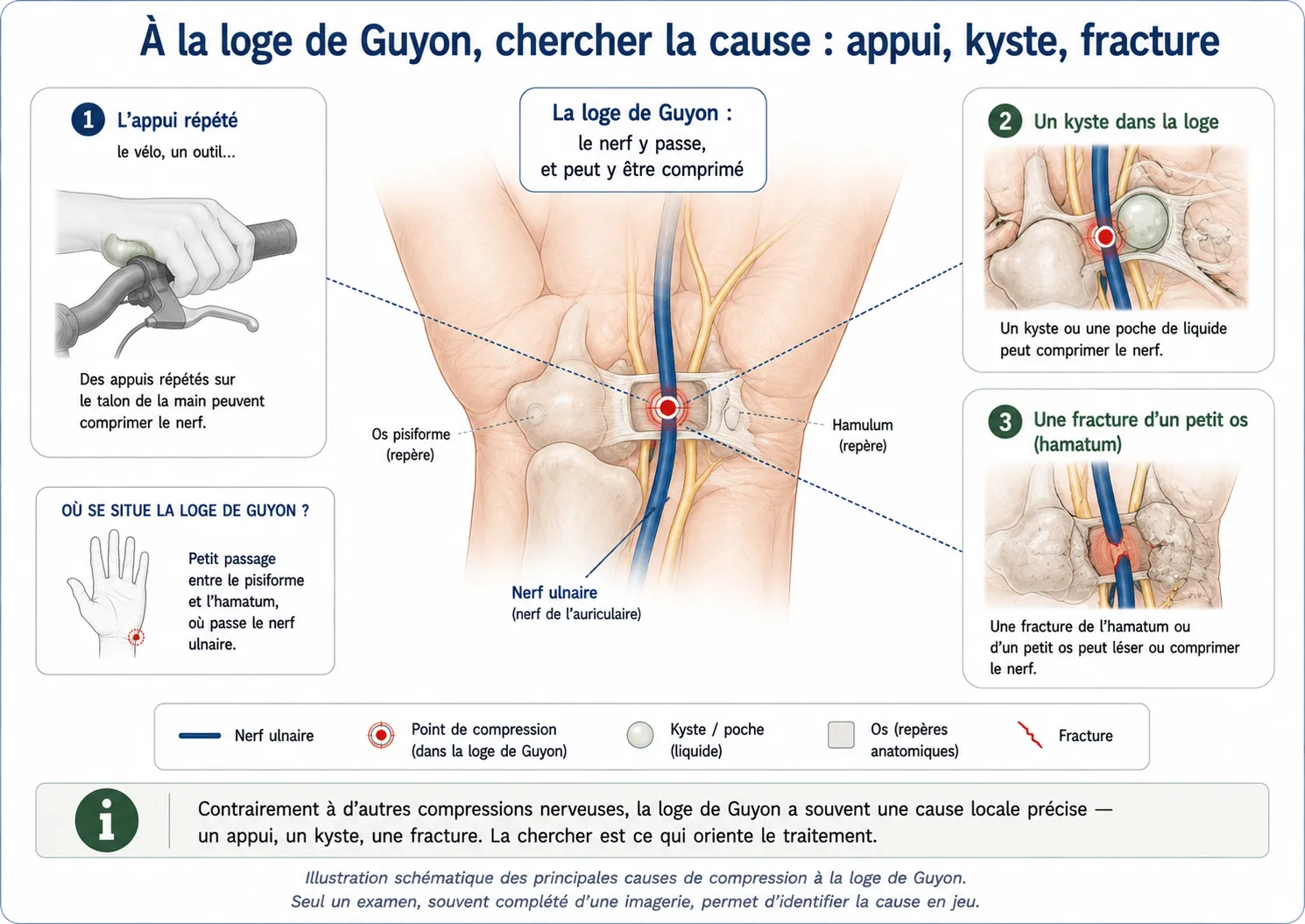 Atteinte du nerf ulnaire au niveau de la loge de Guyon et en aval ( 2a) — illustration médicale