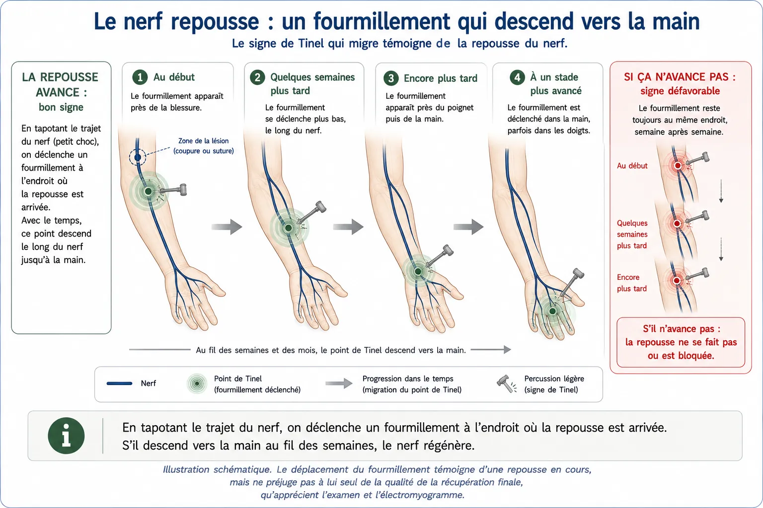Lésions traumatiques des nerfs — illustration médicale