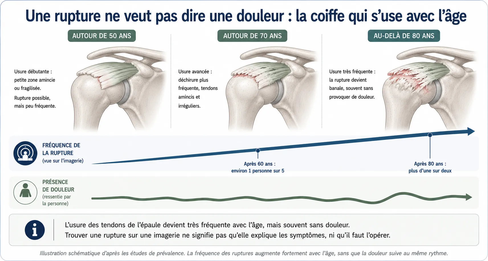 Rupture de la coiffe des rotateurs — illustration médicale