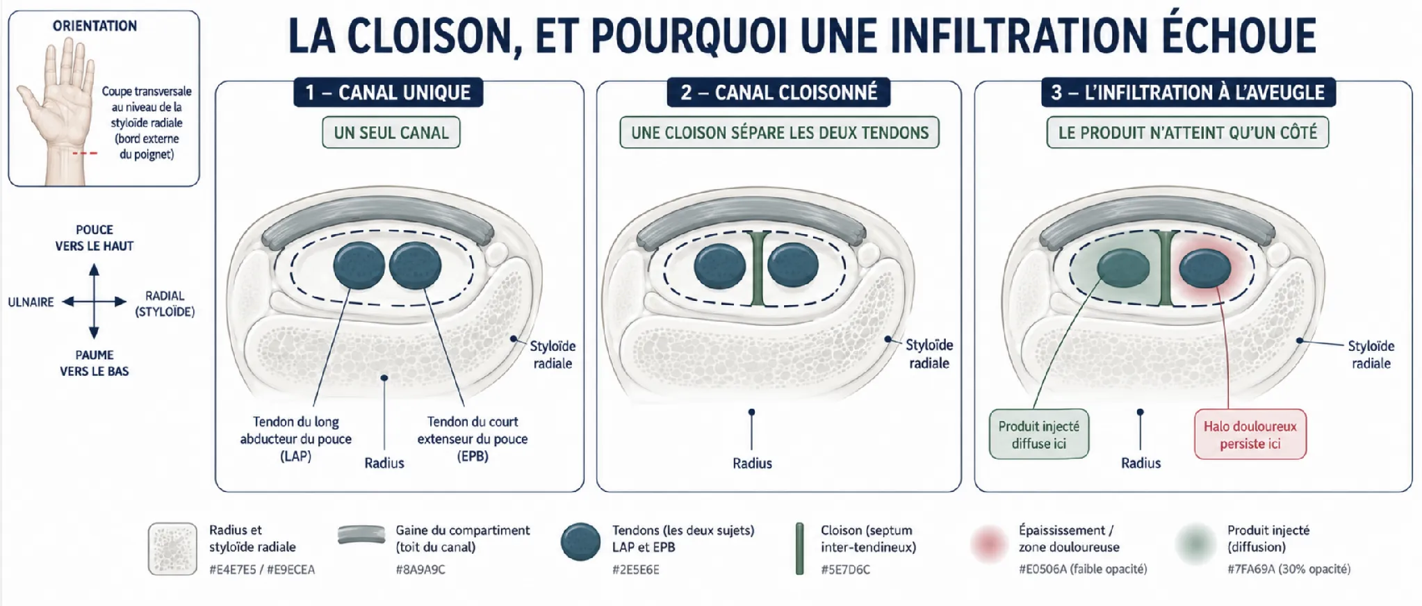 Ténosynovite de De Quervain — illustration médicale