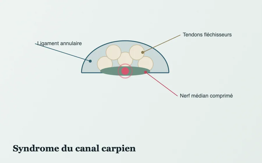Schéma anatomique du canal carpien : nerf médian, tendons fléchisseurs et rétinaculum des fléchisseurs